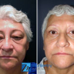 Eyelid Lift photo gallery by Dr. Josue Lara Ontiveros from Monterrey Plastic Surgery.