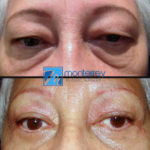 Eyelid Lift photo gallery by Dr. Josue Lara Ontiveros from Monterrey Plastic Surgery.