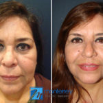 Facelift photo gallery by Dr. Josue Lara Ontiveros from Monterrey Plastic Surgery.