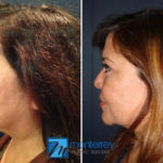 Facelift photo gallery by Dr. Josue Lara Ontiveros from Monterrey Plastic Surgery.