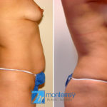 Mommy Makeover photo gallery by Dr. Josue Lara Ontiveros from Monterrey Plastic Surgery.