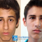 Rhinoplasty photo gallery by Dr. Josue Lara Ontiveros from Monterrey Plastic Surgery.