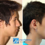 Rhinoplasty photo gallery by Dr. Josue Lara Ontiveros from Monterrey Plastic Surgery.