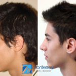 Rhinoplasty photo gallery by Dr. Josue Lara Ontiveros from Monterrey Plastic Surgery.