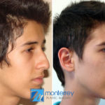 Rhinoplasty photo gallery by Dr. Josue Lara Ontiveros from Monterrey Plastic Surgery.