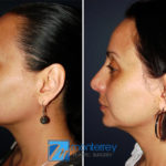 Rhinoplasty photo gallery by Dr. Josue Lara Ontiveros from Monterrey Plastic Surgery.