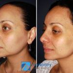 Rhinoplasty photo gallery by Dr. Josue Lara Ontiveros from Monterrey Plastic Surgery.