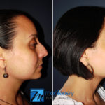 Rhinoplasty photo gallery by Dr. Josue Lara Ontiveros from Monterrey Plastic Surgery.