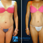 Tummy Tuck photo gallery by Dr. Josue Lara Ontiveros from Monterrey Plastic Surgery.