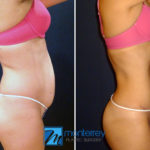 Tummy Tuck photo gallery by Dr. Josue Lara Ontiveros from Monterrey Plastic Surgery.