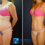 Tummy Tuck photo gallery by Dr. Josue Lara Ontiveros from Monterrey Plastic Surgery.