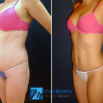 Tummy Tuck photo gallery by Dr. Josue Lara Ontiveros from Monterrey Plastic Surgery.