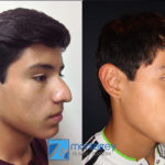 Rhinoplasty photo gallery by Dr. Josue Lara Ontiveros from Monterrey Plastic Surgery.