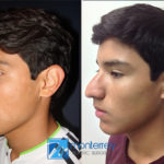 Rhinoplasty photo gallery by Dr. Josue Lara Ontiveros from Monterrey Plastic Surgery.