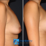 Breast lift photo gallery by Dr. Josue Lara Ontiveros from Monterrey Plastic Surgery.